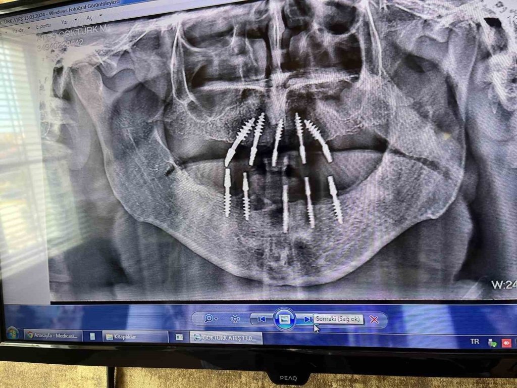 bilecik-haber_fizyomer-dis-hekimi-monoblok-implantin-avantajlarindan-bahsetti-6551.jpg