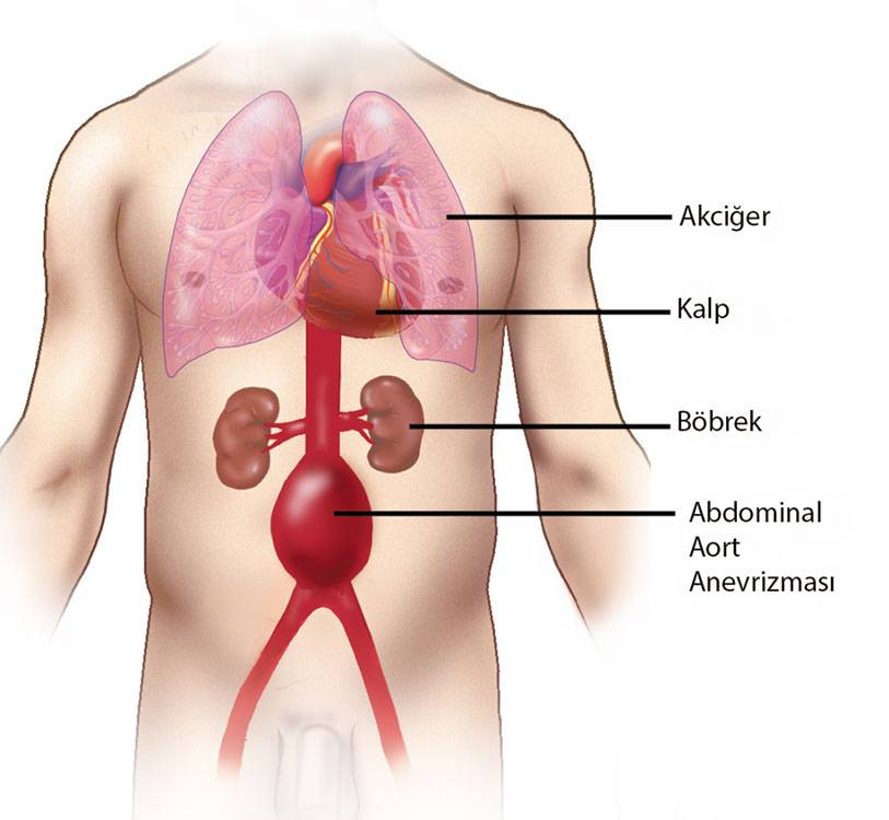 Aort Damarı Yırtılması (Diseksiyonu) Nedir?