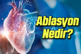 ablasyon